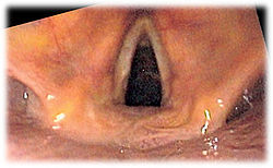 Vocal Cords (looking down the trachea or windpipe)